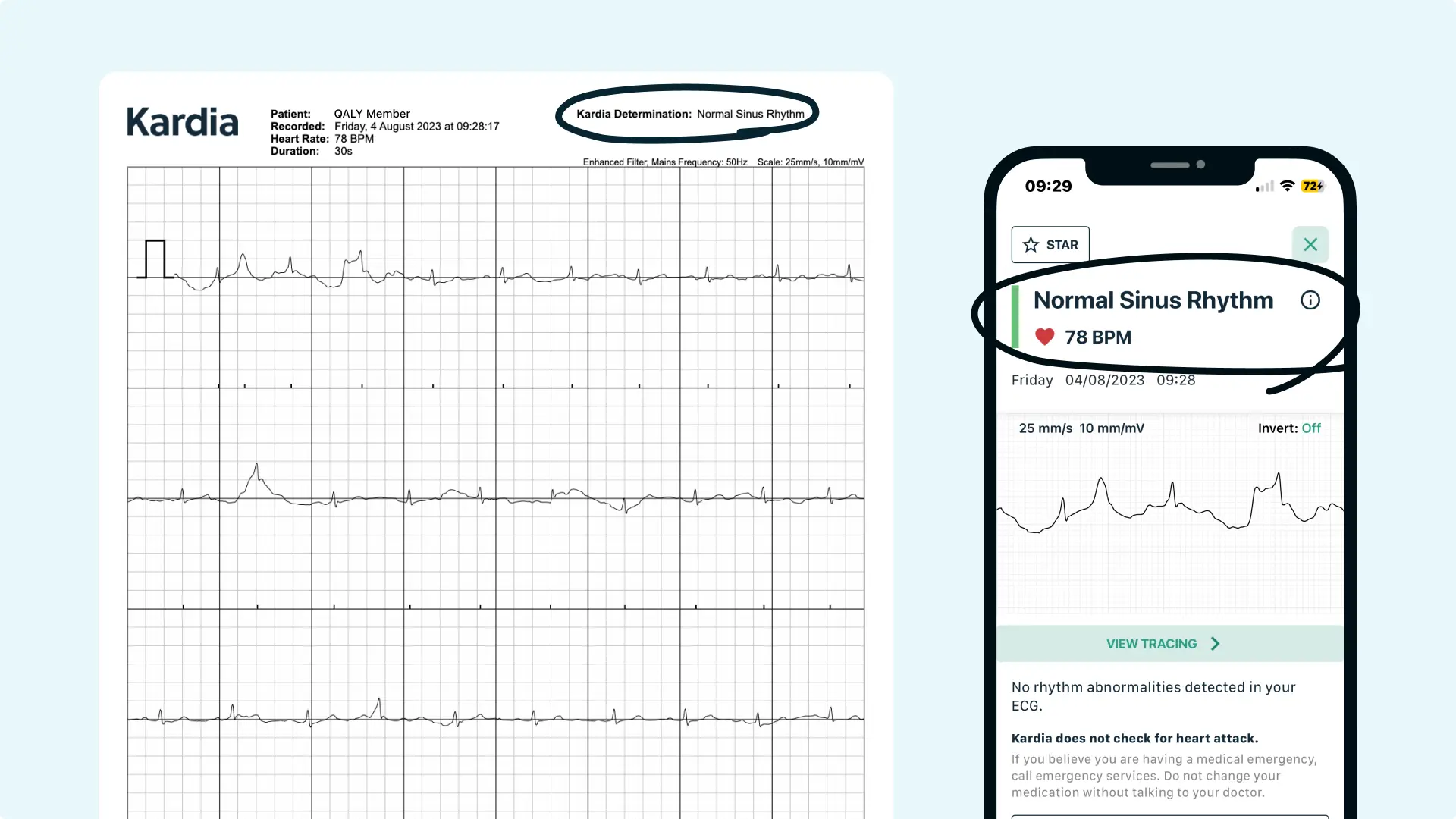 What Unclassified EKG Means on Your KardiaMobile Qaly